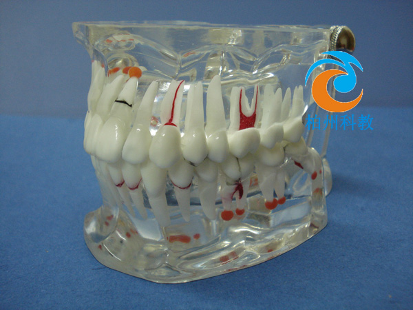 综合病理水晶牙列模型(32颗牙)