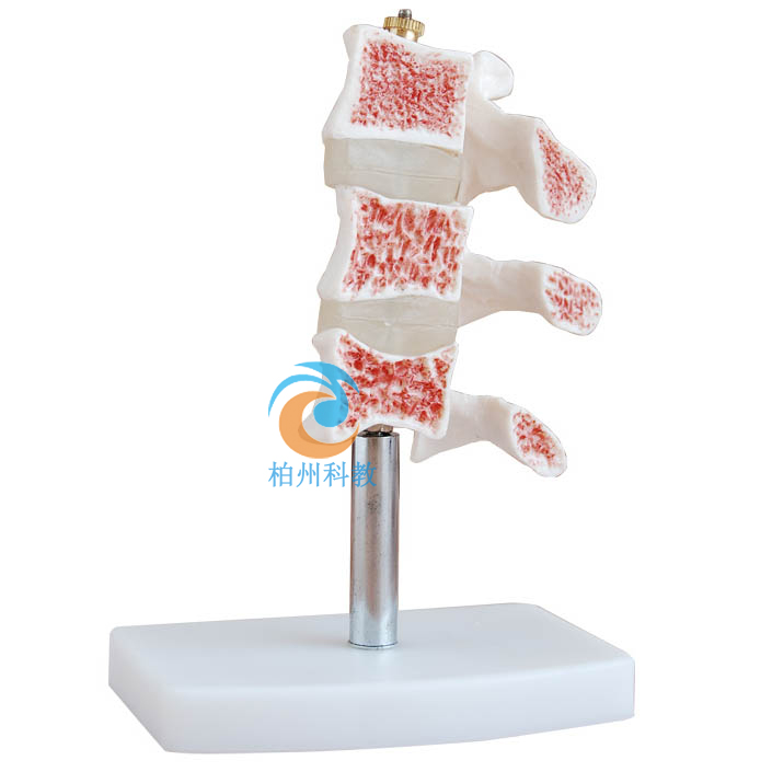 骨质疏松模型(脊椎典型病变模型)