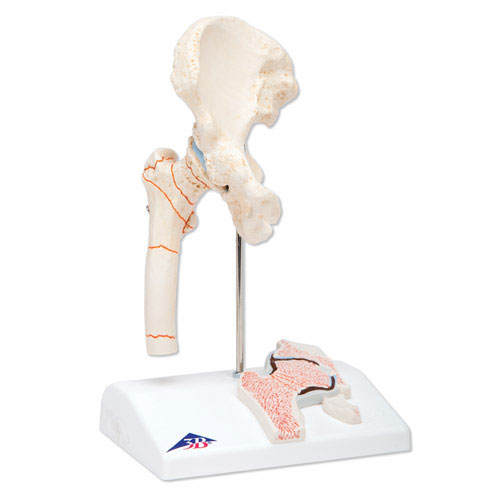 进口大腿骨折和髋关节炎模型-德国3B-A88